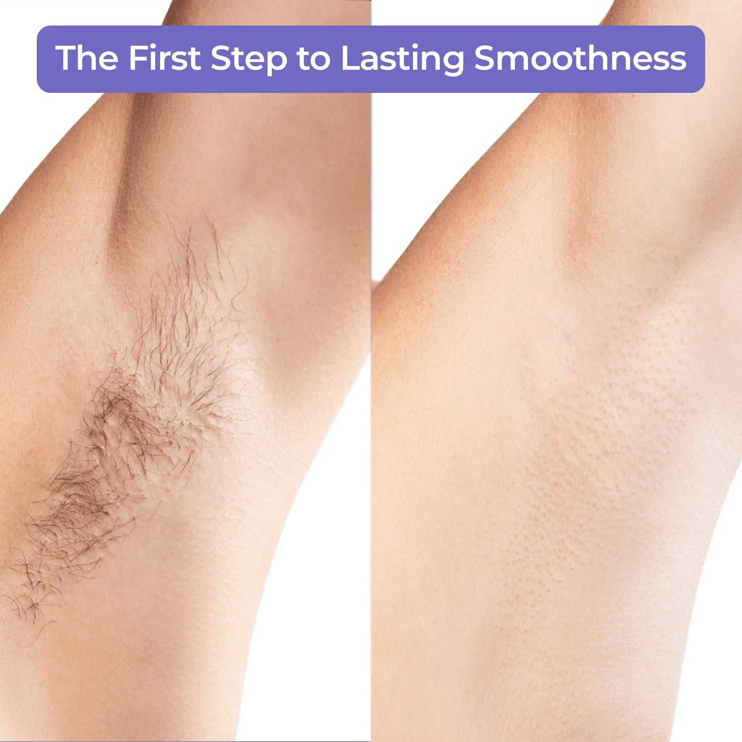 IPL Hair Laser Removal