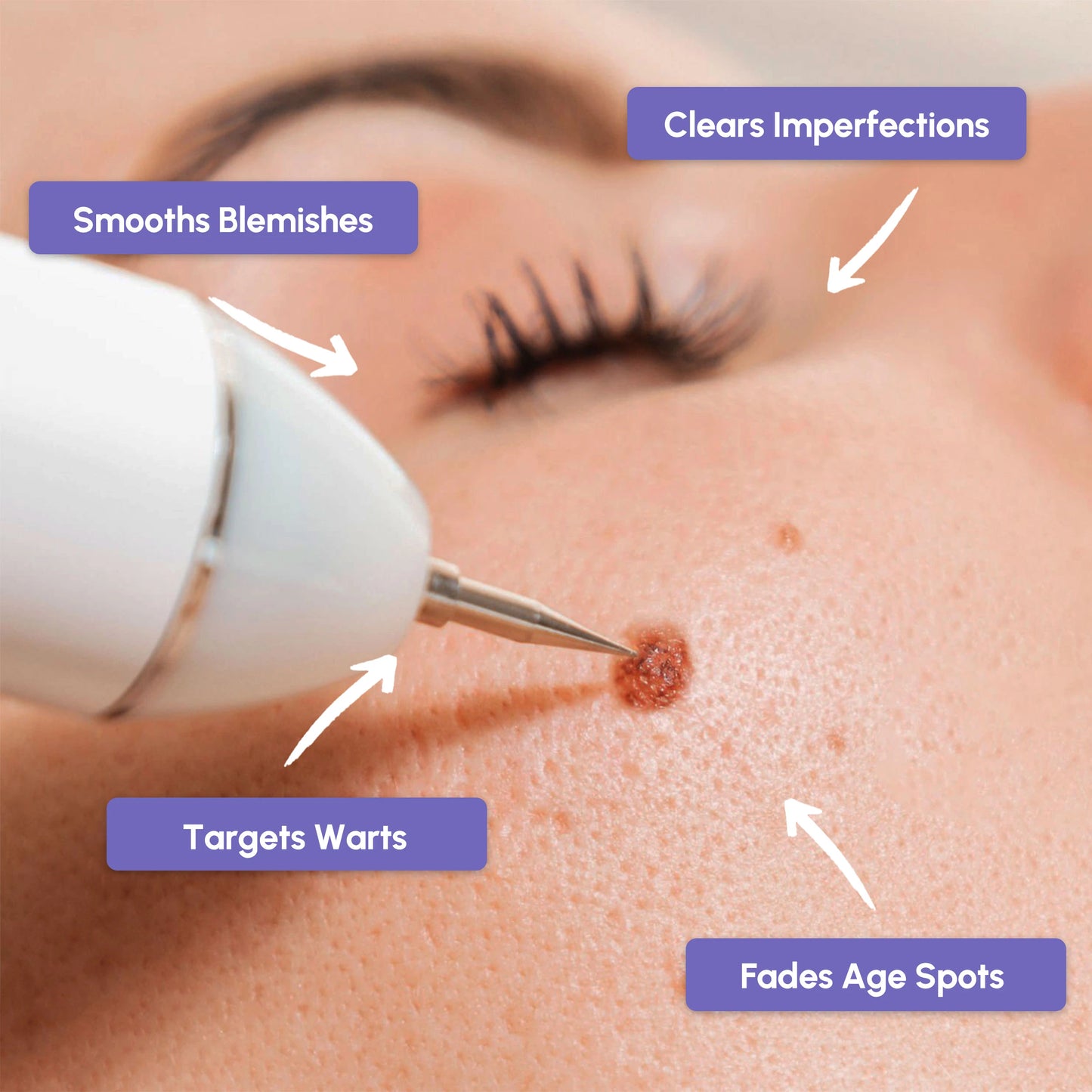 Remover Pen for Moles