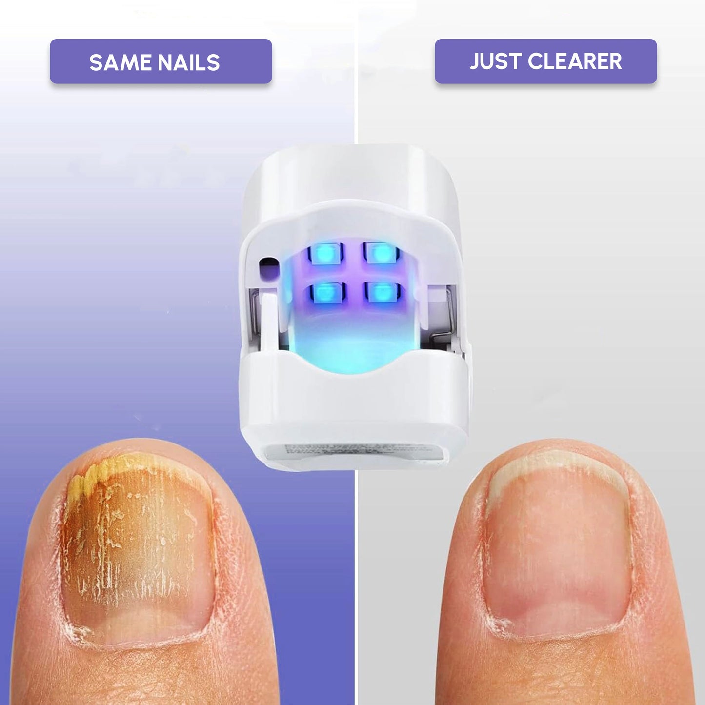 Nail Fungus Therapy Device